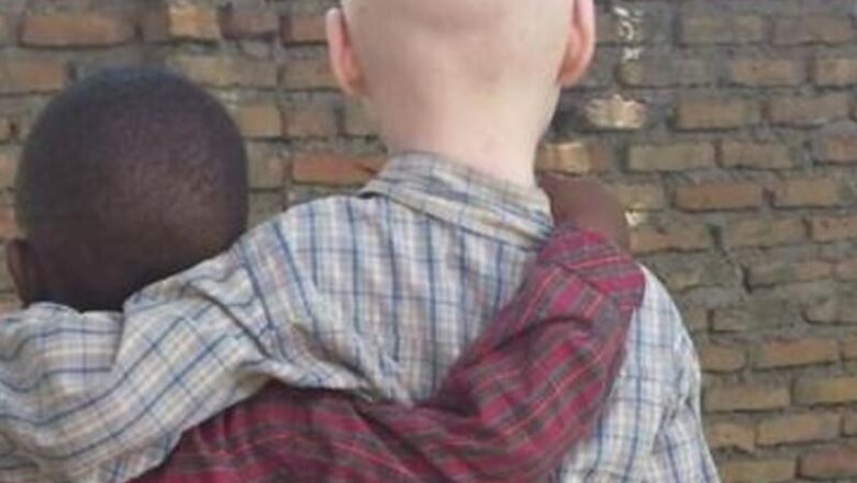 Nord-Kivu: La marginalisation des enfants albinos gagne du terrain dans les sites des déplacés !